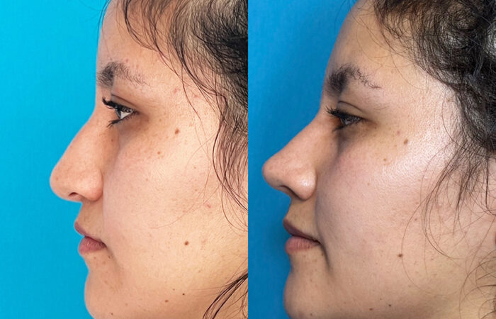 Resultado de rinoplastia estética y funcional en Quito - Dra. Victoria Moncayo