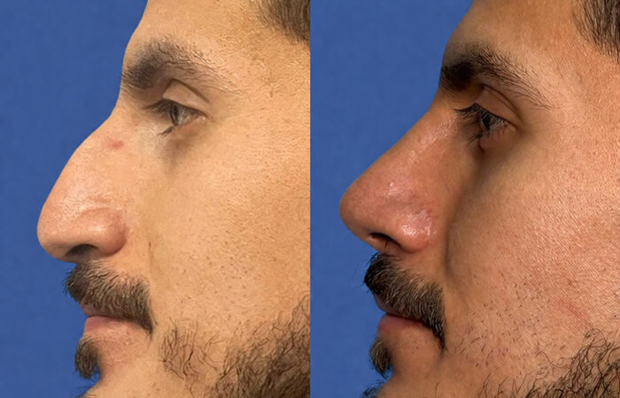 Cirugía de tabique desviado y estética nasal en Quito - Paciente real