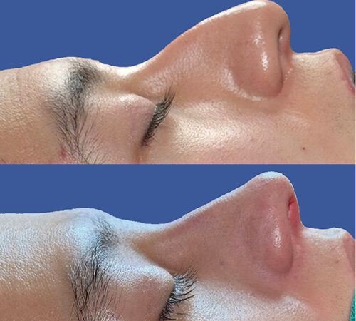 Cirugía de tabique desviado y estética nasal en Quito - Paciente real