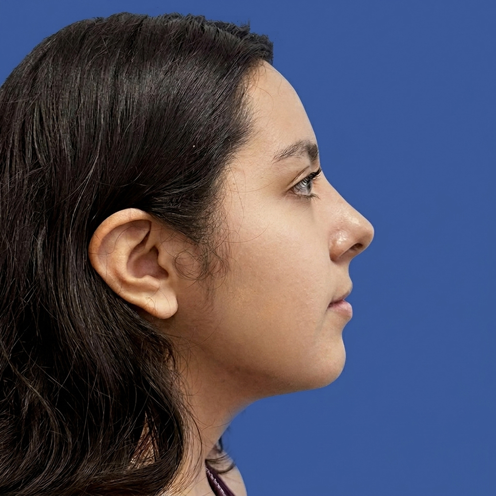 Cirugía de tabique desviado y estética nasal en Quito - Paciente real , Cirugía de nariz femenina