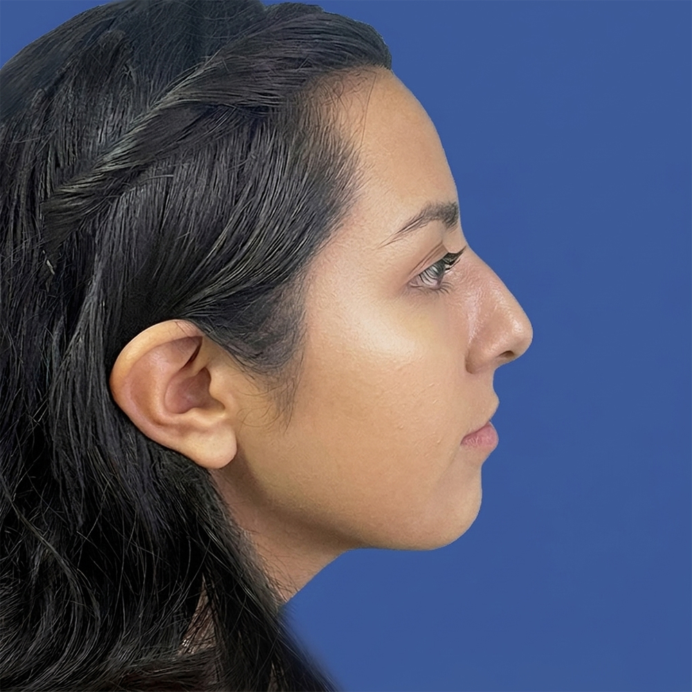 Cirugía de tabique desviado y estética nasal en Quito - Paciente real , Cirugía de nariz femenina