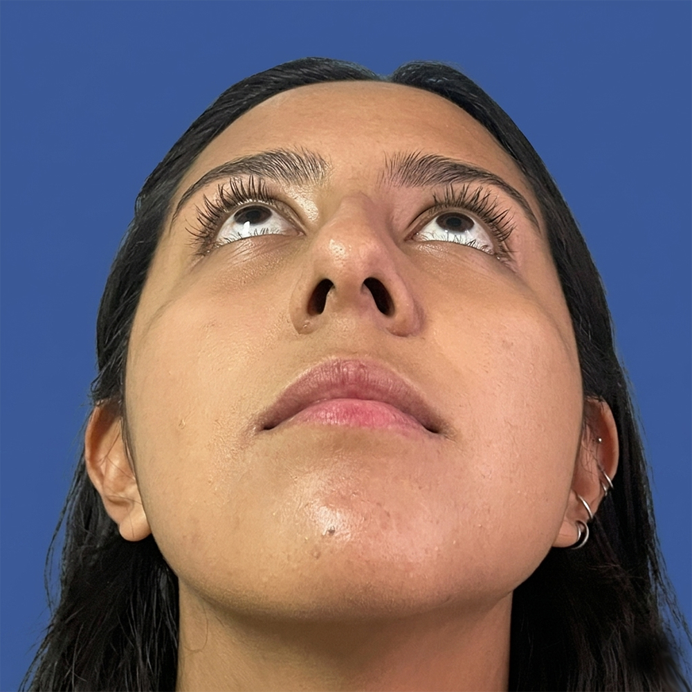 Cirugía de tabique desviado y estética nasal en Quito - Paciente real , Cirugía de nariz femenina