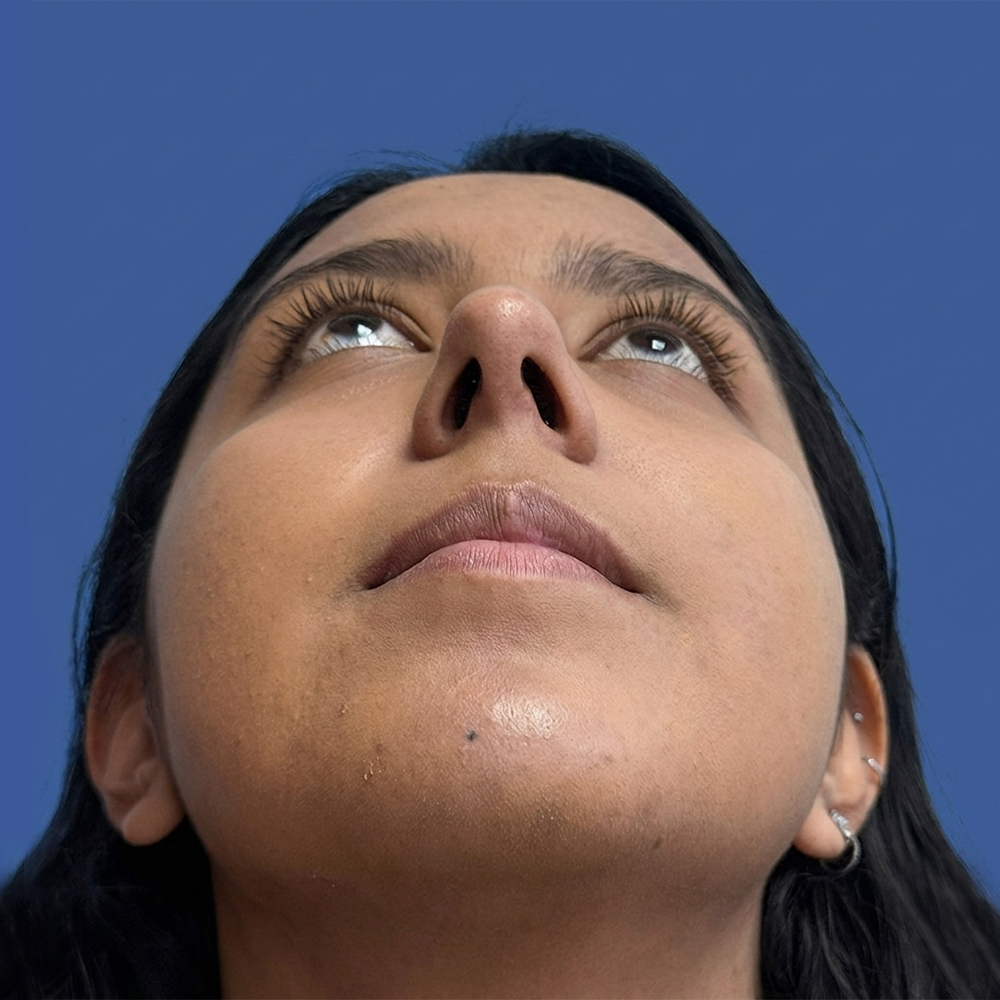 Cirugía de tabique desviado y estética nasal en Quito - Paciente real , Cirugía de nariz femenina-Dra. Victoria Moncayo