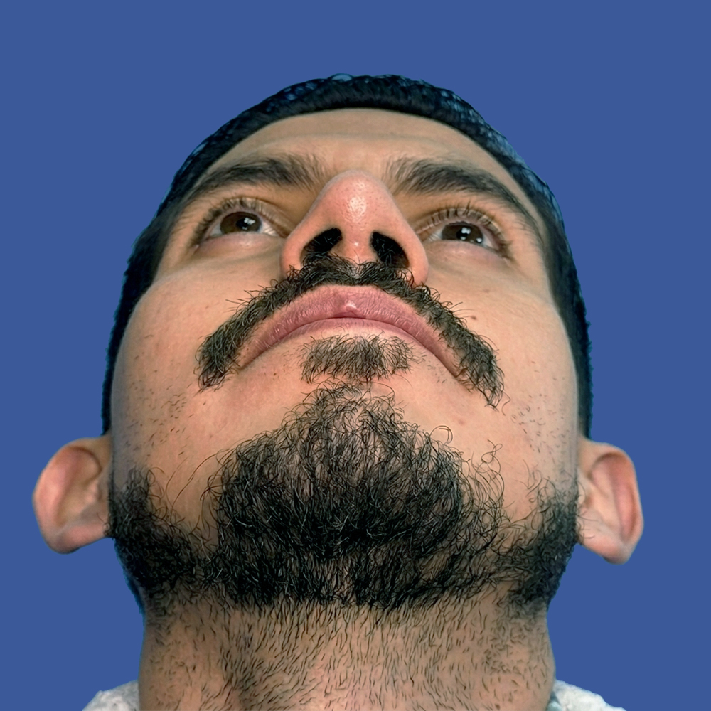 Dra. Victoria Moncayo, Cirugía masculina de tabique desviado y estética nasal en Quito - Paciente real, rinoplastia