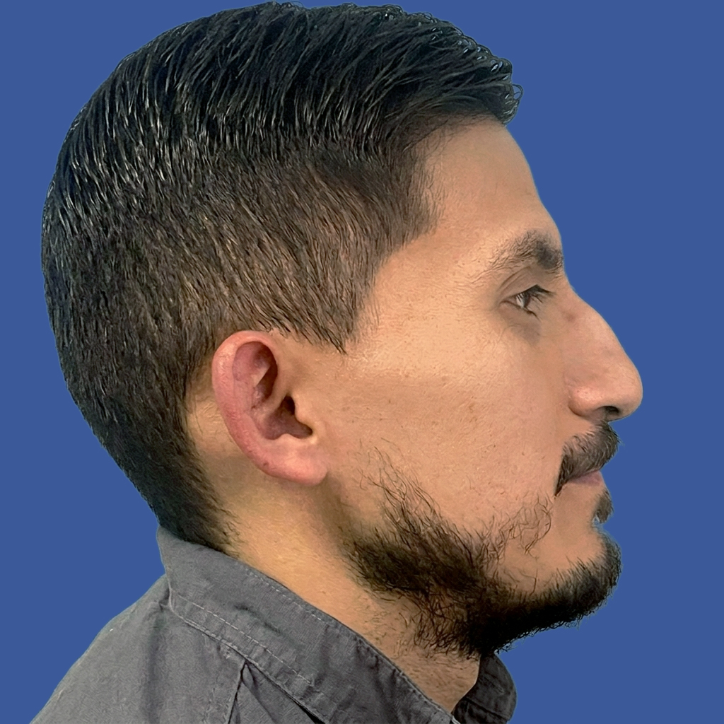 Dra. Victoria Moncayo, Cirugía masculina de tabique desviado y estética nasal en Quito - Paciente real, rinoplastia
