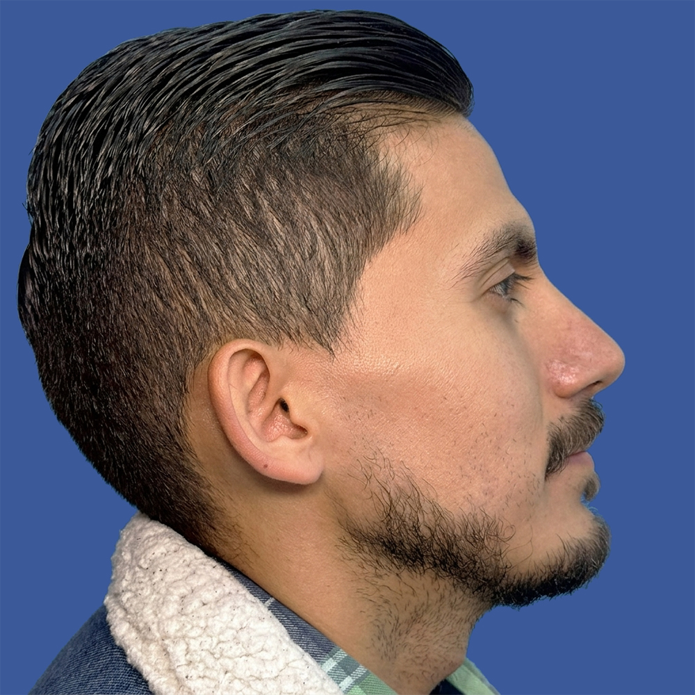 Cirugía masculina de tabique desviado y estética nasal en Quito - Paciente real, rinoplastia, Dra. Victoria Moncayo
