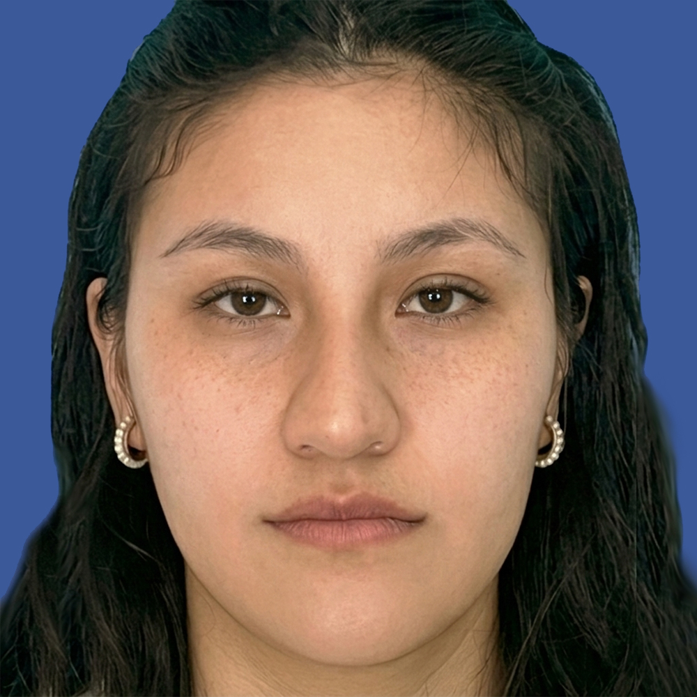 Cirugía de tabique desviado y estética nasal en Quito - Paciente real , Cirugía de nariz femenina-Dra. Victoria Moncayo
