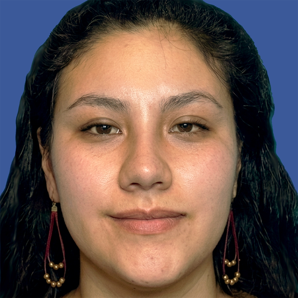 Cirugía de tabique desviado y estética nasal en Quito - Paciente real , Cirugía de nariz femenina-Dra. Victoria Moncayo