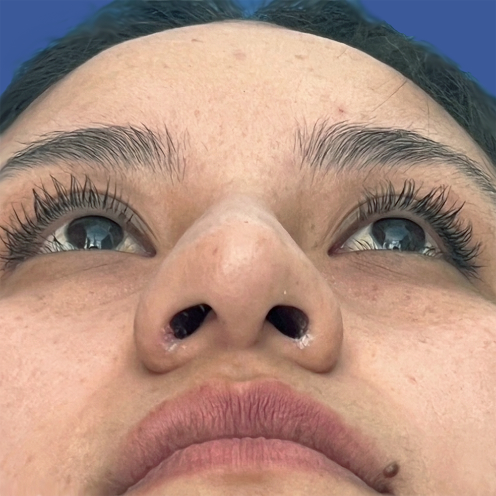 Cirugía de tabique desviado y estética nasal en Quito - Paciente real , Cirugía de nariz femenina-Dra. Victoria Moncayo