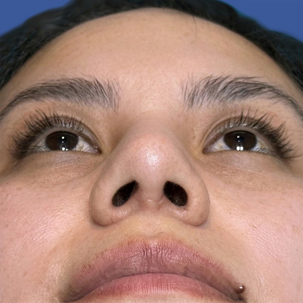 Cirugía de tabique desviado y estética nasal en Quito - Paciente real , Cirugía de nariz femenina-Dra. Victoria Moncayo