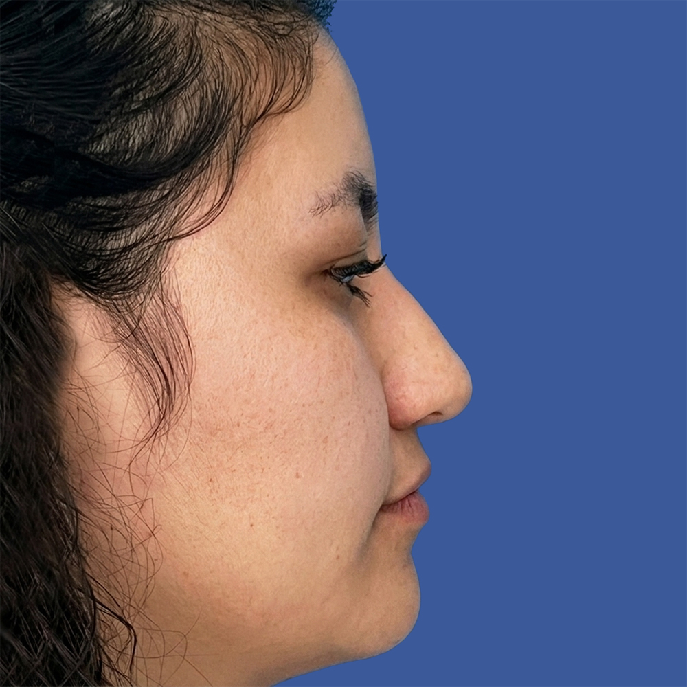 Cirugía de tabique desviado y estética nasal en Quito - Paciente real , Cirugía de nariz femenina-Dra. Victoria Moncayo