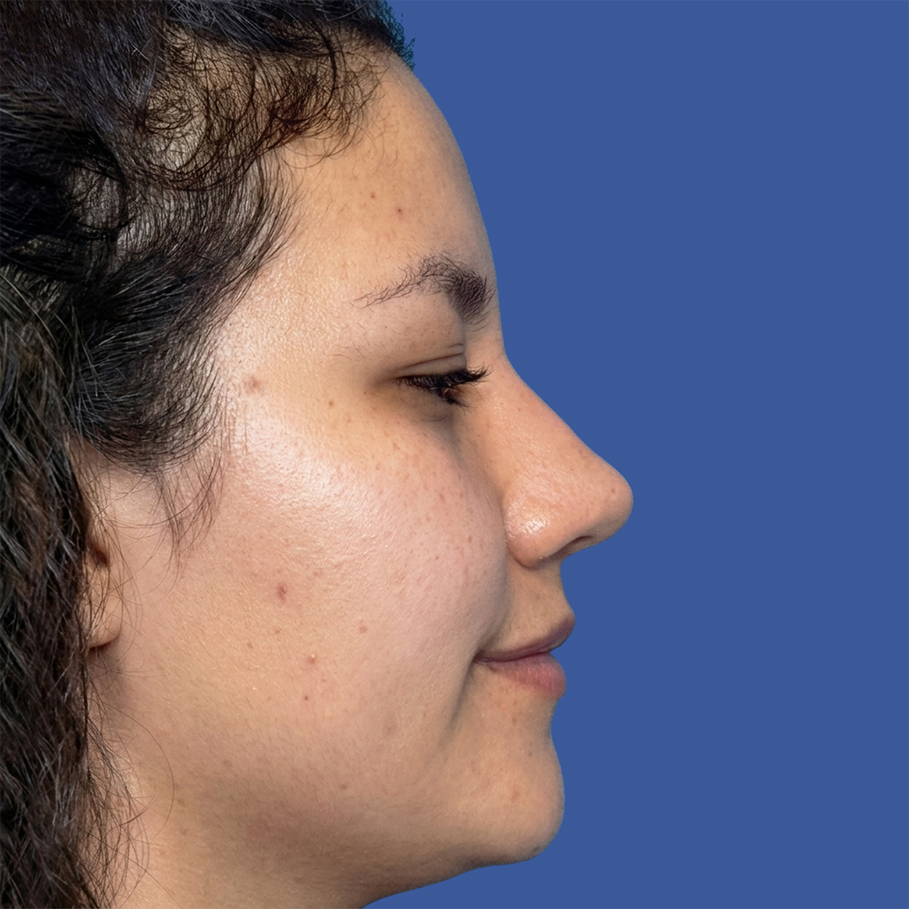 Cirugía de tabique desviado y estética nasal en Quito - Paciente real , Cirugía de nariz femenina-Dra. Victoria Moncayo