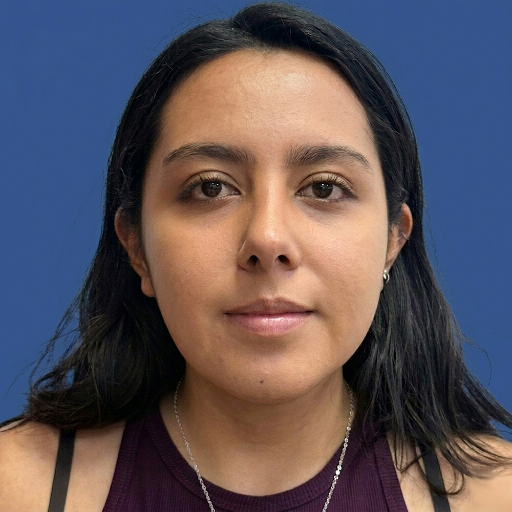 Cirugía de tabique desviado y estética nasal en Quito - Paciente real , Cirugía de nariz femenina