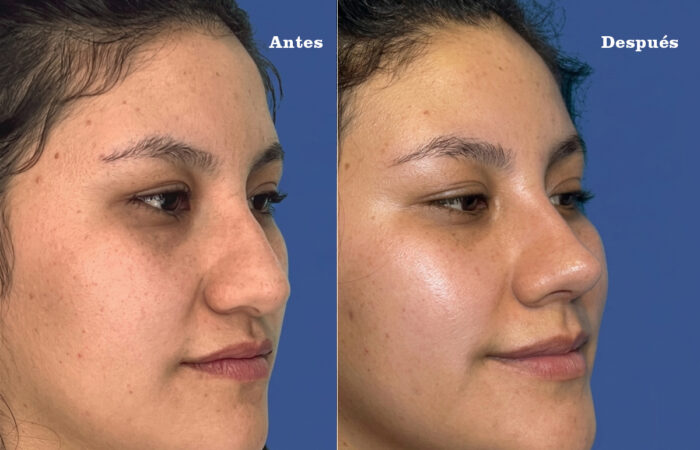 Cirugía de tabique y estética nasal en Quito - Paciente real