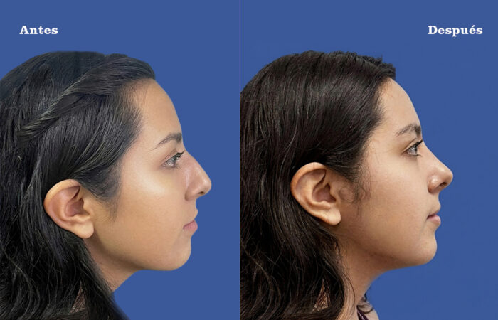 Resultado de rinoplastia estética y funcional en Quito - Dra. Victoria Moncayo