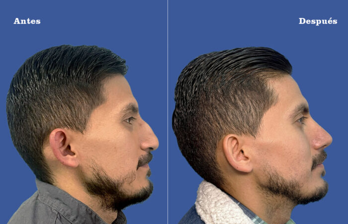 Cirugía de tabique desviado y estética nasal en Quito - Paciente real